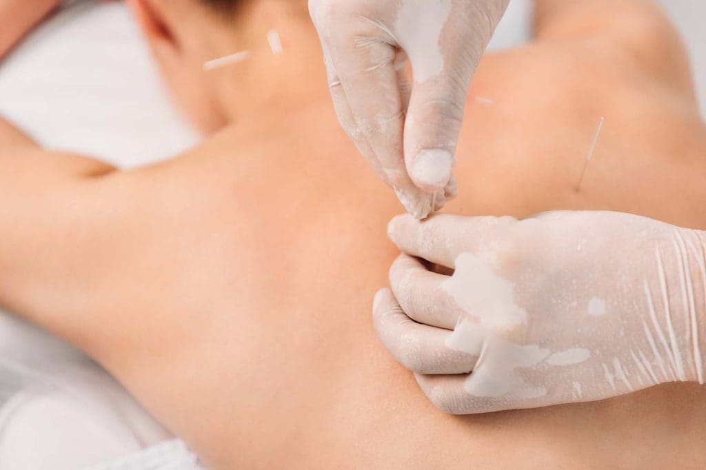 Dry needling treatment being performed by a physiotherapist to relieve muscle tension and improve mobility